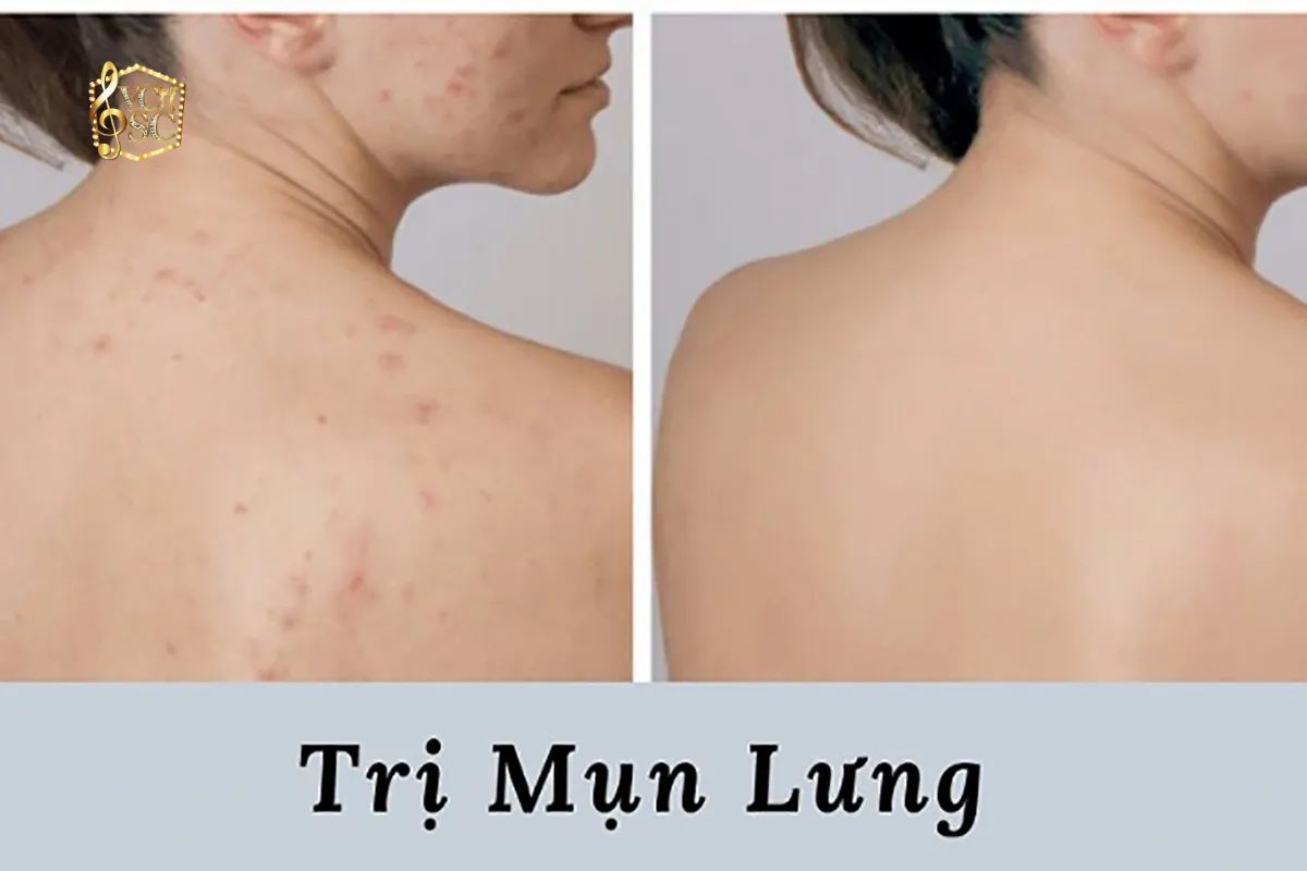 7 Cách Trị Mụn Lưng Và Viêm Nang Lông Tại Nhà Hiệu Quả Dứt Điểm