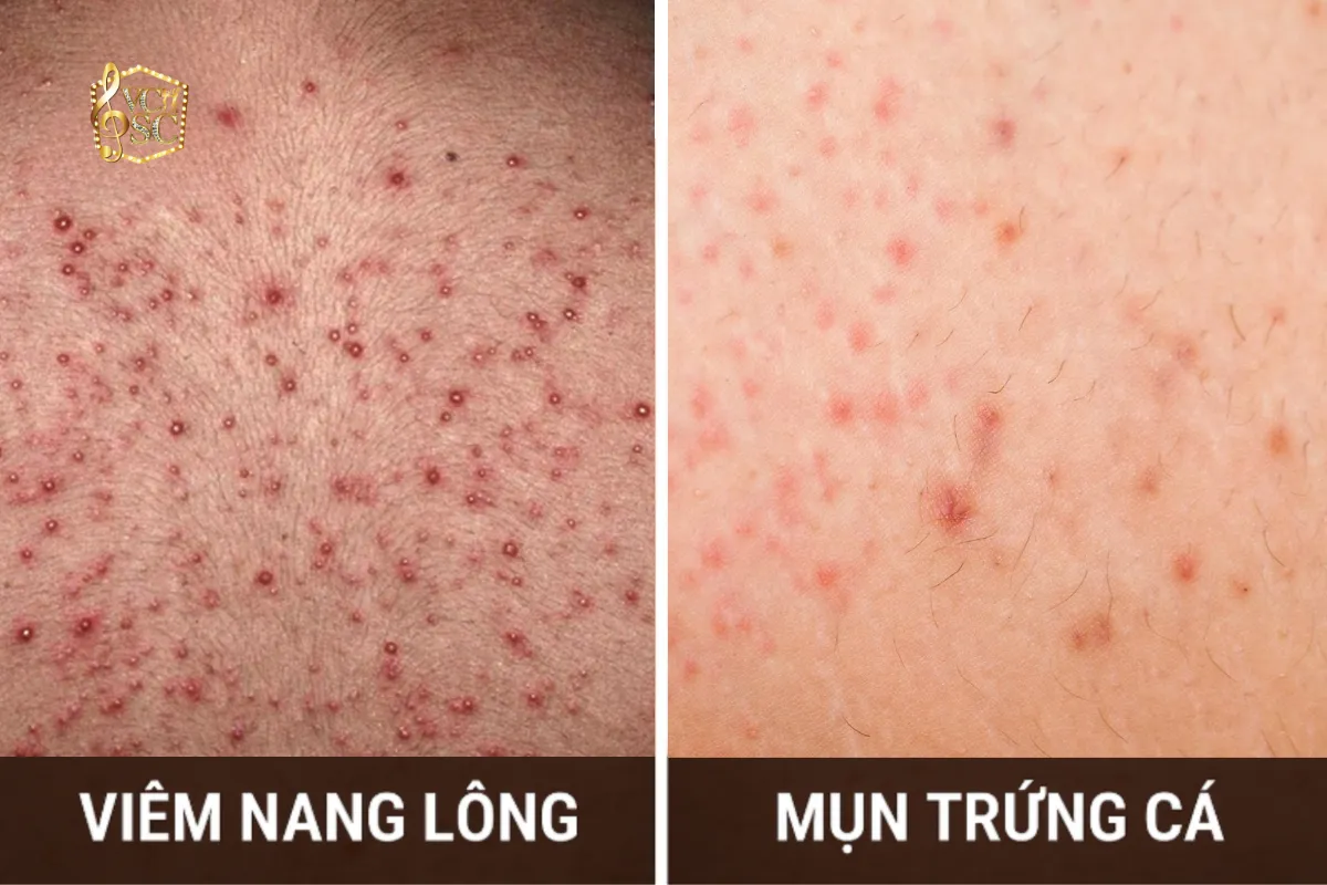 Phân biệt mụn trứng cá và viêm nang lông