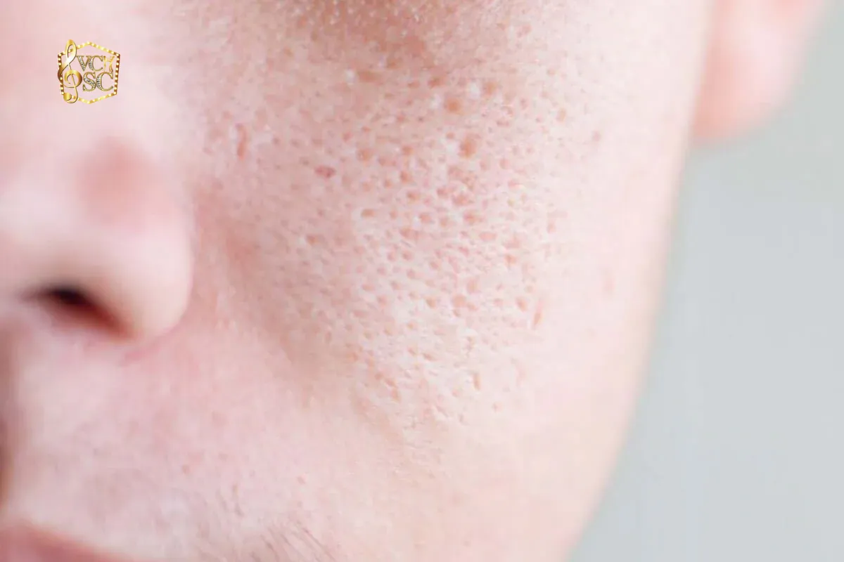 Tại sao lỗ chân lông của bạn lại to bất thường